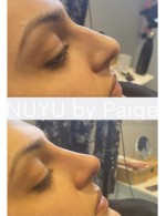 Non Surgical Rhinoplasty