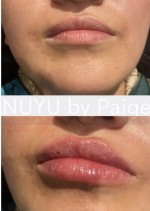 1ml Lip Filler