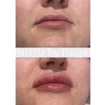 1ml Lip Filler